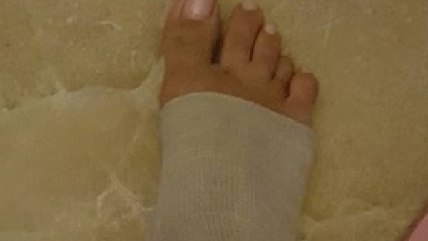 منة فضالي تصاب قدمها