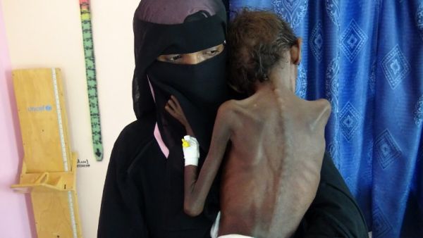 emeni mother Nadia Nahari holding her five-year-old son Abdelrahman Manhash, who is suffering from severe malnutrition and weighing 5 kilograms (AFP)
