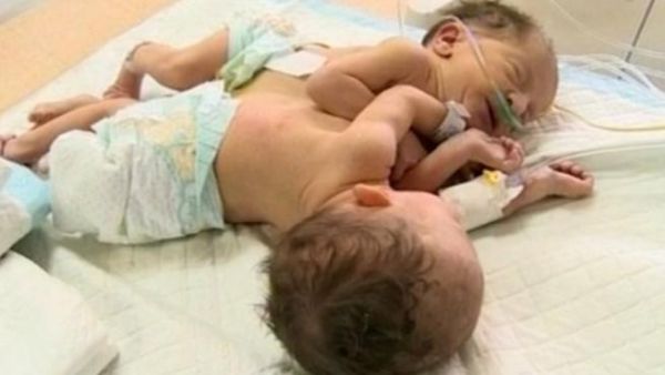 إيمان وإسلام، توأم سيامي ترقدان على سرير العناية الطبية، وتحت أنظار أمهما، التي رفضت إجهاضها أثناء حملها.