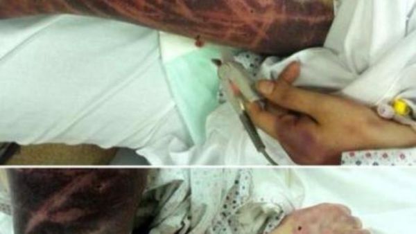 امرأة سعودية ضربها زوجها بالمفك!