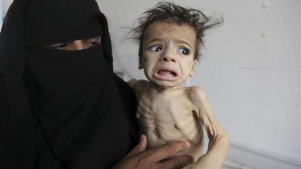اليمن يعاني من أزمة غذائية اليمن يعاني من أزمة غذائية