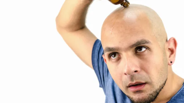 الصلع عند الرجال بسبب زيادة إفراز هرمون الذكورة "الأندروجين" 
