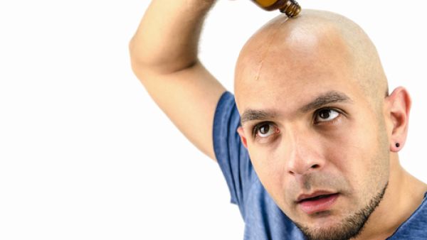 الصلع عند الرجال بسبب زيادة إفراز هرمون الذكورة "الأندروجين" 