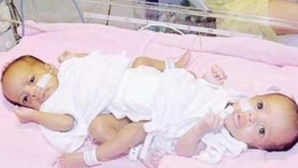 التوأمان السعوديتان رنا وريم     التوأمان السعوديتان رنا وريم