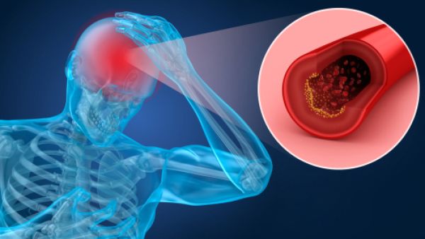 الجلطة الدماغيّة هي نوبة مفاجئة يحدث فيها تمزق في وعاء دموي دماغي