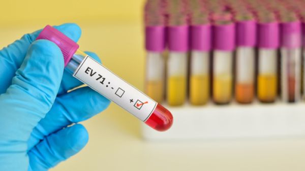 العلماء لم يتوصلوا بعد إلى لقاح يمنع انتشار عدوى فيروس كوكساكي
