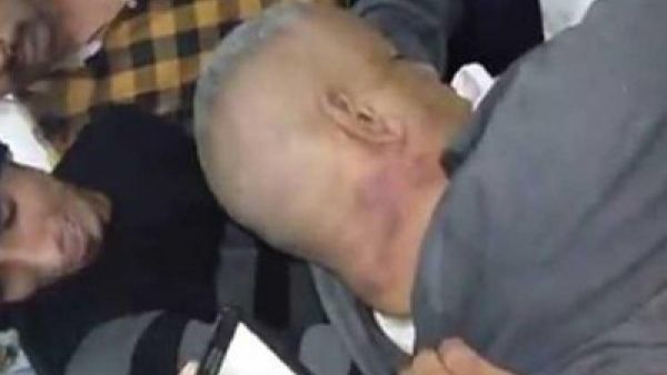  آثار التعذيب على طلعت شبيب (47 عاما)