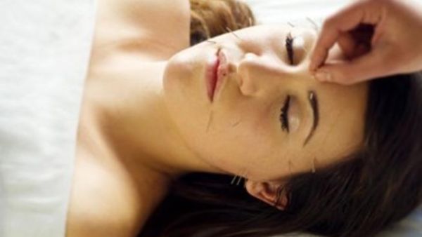 ما هو الوخز بالأبر التجميلي ؟

