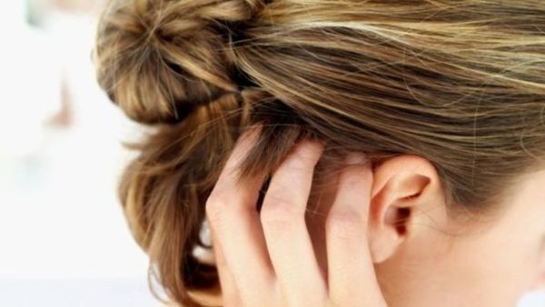 تسبب قشرة الرأس الإحراج للكثيرين سواء الرجال أم النساء