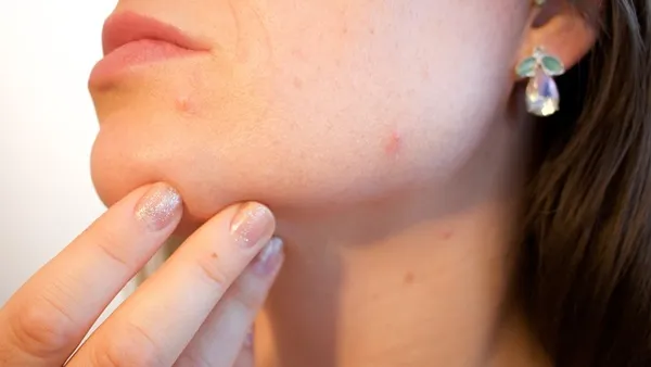 يمكن أن يؤدي تطبيق المعجون على البثور أو حب الشباب أيضًا إلى حدوث ندوب