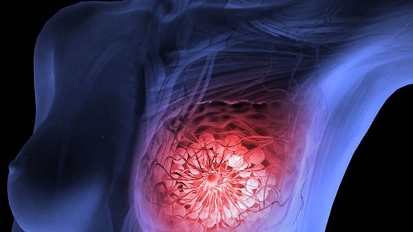 هل هناك علاج لسرطان الثدي؟