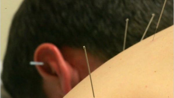 الوخز بالابر من العلاجات التقليدية التي تساعد في تخفيف الكثير من الأمراض