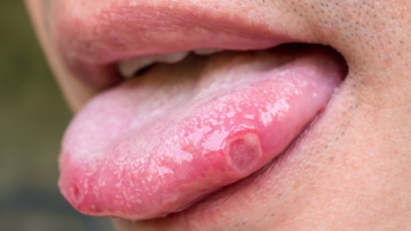 حمو الفم هو عبارة عن تَقرّحاتٍ داخل التجويف الفموي