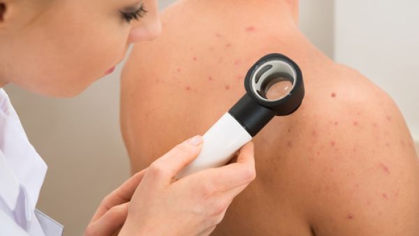 جرّبي شرائح الأناناس على البثور التي تزعجكِ في منطقة الظهر


