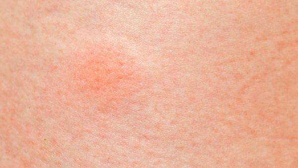 البابونج من الأعشاب الطبيعية التي تساهم في علاج المشاكل الجلدية