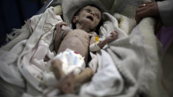 Sahar Difda, a one-year-old Syrian baby suffering from severe malnutrition who died in besieged Eastern Ghouta on Saturday (Amer Almohibany/AFP)
