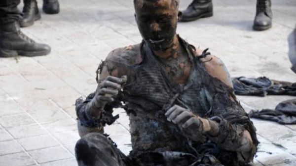 الشاب بعد احراق نفسه