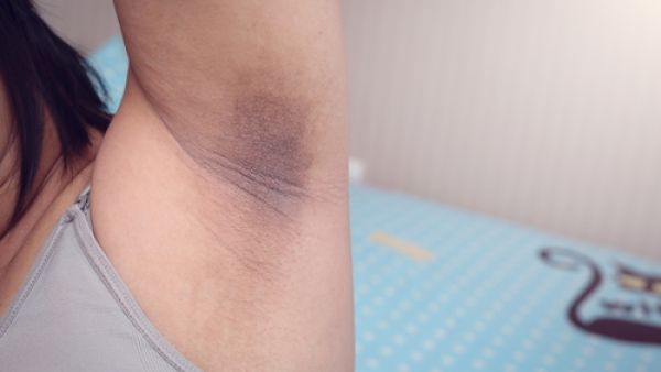 تعتبر منطقة الإبطين بيئة ملائمة لنمو الفطريات التي تسبب إحمرارا في الجلد