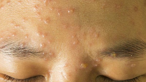 Chicken pox. (Shutterstock) Chicken pox. (Shutterstock)