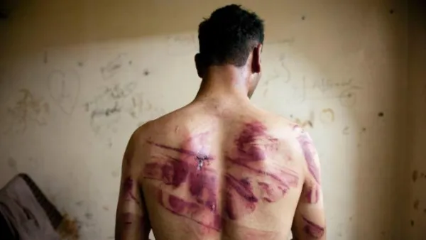 A Syrian man shows marks of torture on his back, after he was released from regime forces, in the Bustan Pasha neighborhood of Syria's northern city of Aleppo on August 23, 2012 (AFP/James Lawler Duggan)