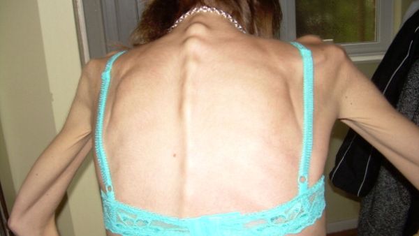 Hot? NOT! Anorexia is growing throughout the world and the Middle East is no exception. 