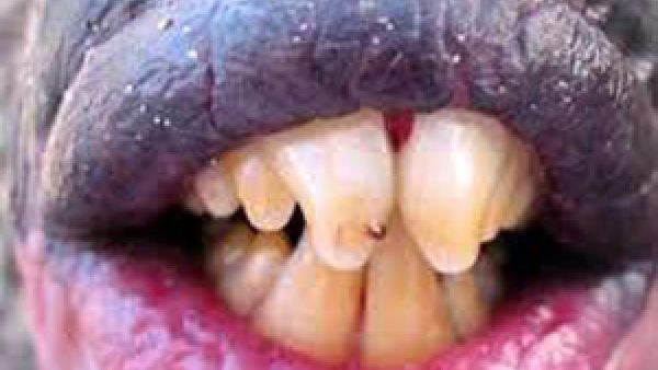 اسنان اللولي