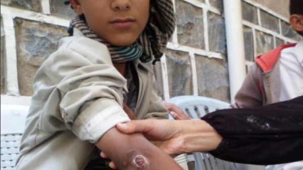 Naharri shows off his scars