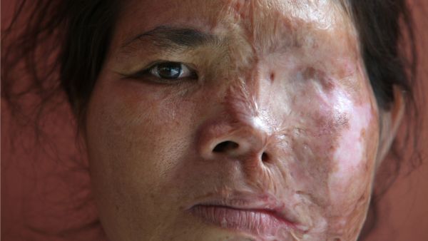 Acid violence is quite a common practice in many Far Eastern countries such as Cambodia, Sri Lanka, Indonesia