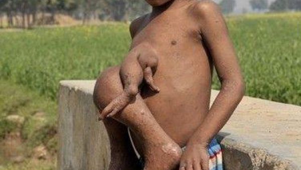 يستند الى السور وتؤأمه يتدلى من بطنه