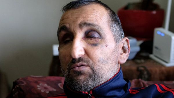 منذر مزهر واثار اللكمات بادية في وجهه