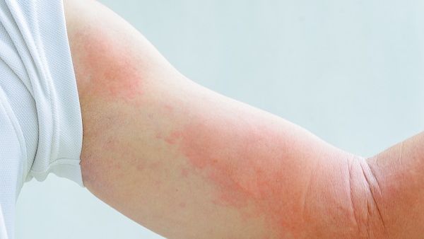 Symptoms of an Allergic Reaction to Insect Bites Can Include Rash Symptoms of an Allergic Reaction to Insect Bites Can Include Rash