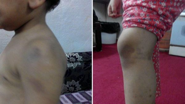 اثار الضرب على جسد الاطفال