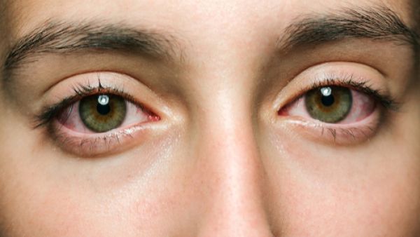 تشمل أعراض الحساسية احمراراً في العين أو الجفن الداخلي للعين (shutterstock.com)