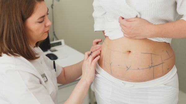 الكمية المسموح بإزالتها وفقاً للمعايير العالمية هي 5- 7 % من وزن الشخص (shutterstock.com)
