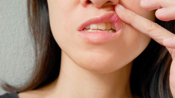 حدوث التقرحات الفموية نتيجة نقص في بعض الفيتامينات