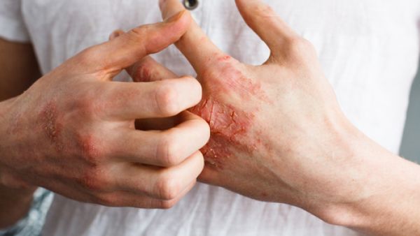 قد تصبح الأكزيما ملتهبة عندما تكون على اتصال مع مهيج معين