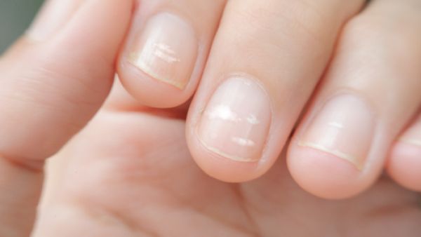 نقص الرطوبة يمكن أن تسبب ظهور هذه الخطوط الطويلة على الأظافر