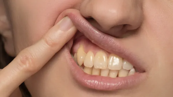 إصفرار الأسنان أكثر المشاكل التي نعاني منها وتسبب الخجل (shutterstock.com)