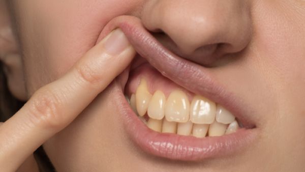 إصفرار الأسنان أكثر المشاكل التي نعاني منها وتسبب الخجل (shutterstock.com)