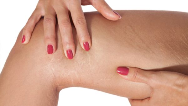 علامات التمدد هي شكل من أشكال الندب غير المؤذية على الجلد (shutterstock.com)
