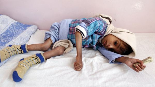 A malnourished Yemeni boy receives treatment at a therapeutic feeding center in Sanaa (Mohammed Huwais/AFP)
