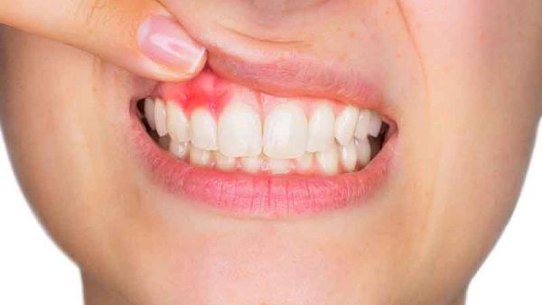 علاج التهاب اللثة وانتفاخها في المنزل