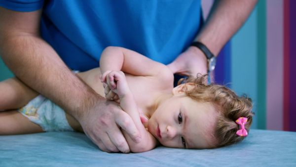 من أعراض الشلل الدماغي العضلات المتصلِّبة مع الانعكاسات العادية (التصلُّب)