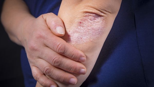عدم علاج الصدفية قد يسبب مشاكل كأمراض القلب والأوعية الدموية والتهاب المفاصل