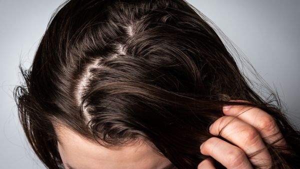 من أسباب ظهور صدفية الشعر تناول بعض الأدوية الطبية