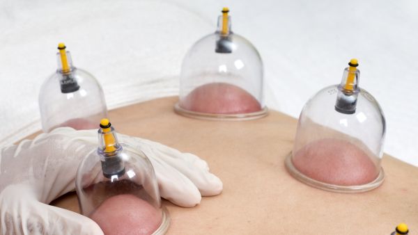 يعتبر العلاج بالحجامة من أشكال الطب البديل 