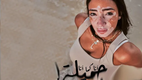 البهاق مرض جلدي يحدث بسبب فقدان لون الجلد الطبيعي وظهور بقع بيضاء 