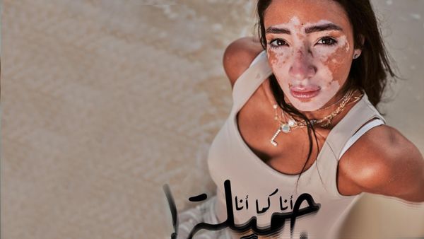 البهاق مرض جلدي يحدث بسبب فقدان لون الجلد الطبيعي وظهور بقع بيضاء 
