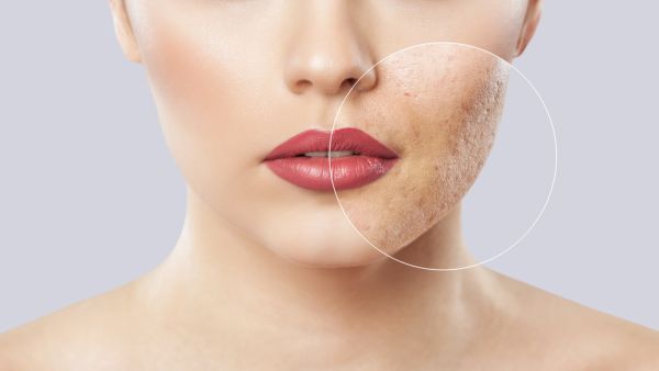 تجنب شرب المياه الغازية والمشروبات المحفوظة فهي من أهم أسباب ظهور حب الشباب