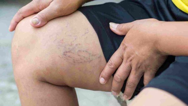تجنب الأطعمة التي تحتوي على الدهون فهي تلحق أضراراً في الأوعية الدموية